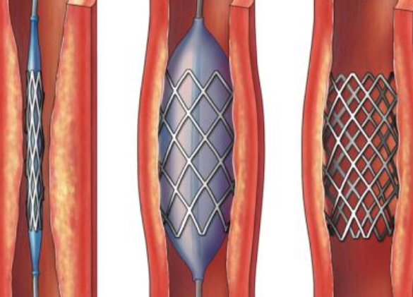 好消息！700元冠脈支架來了帶量采購結(jié)果在甘肅省正式落地執(zhí)行